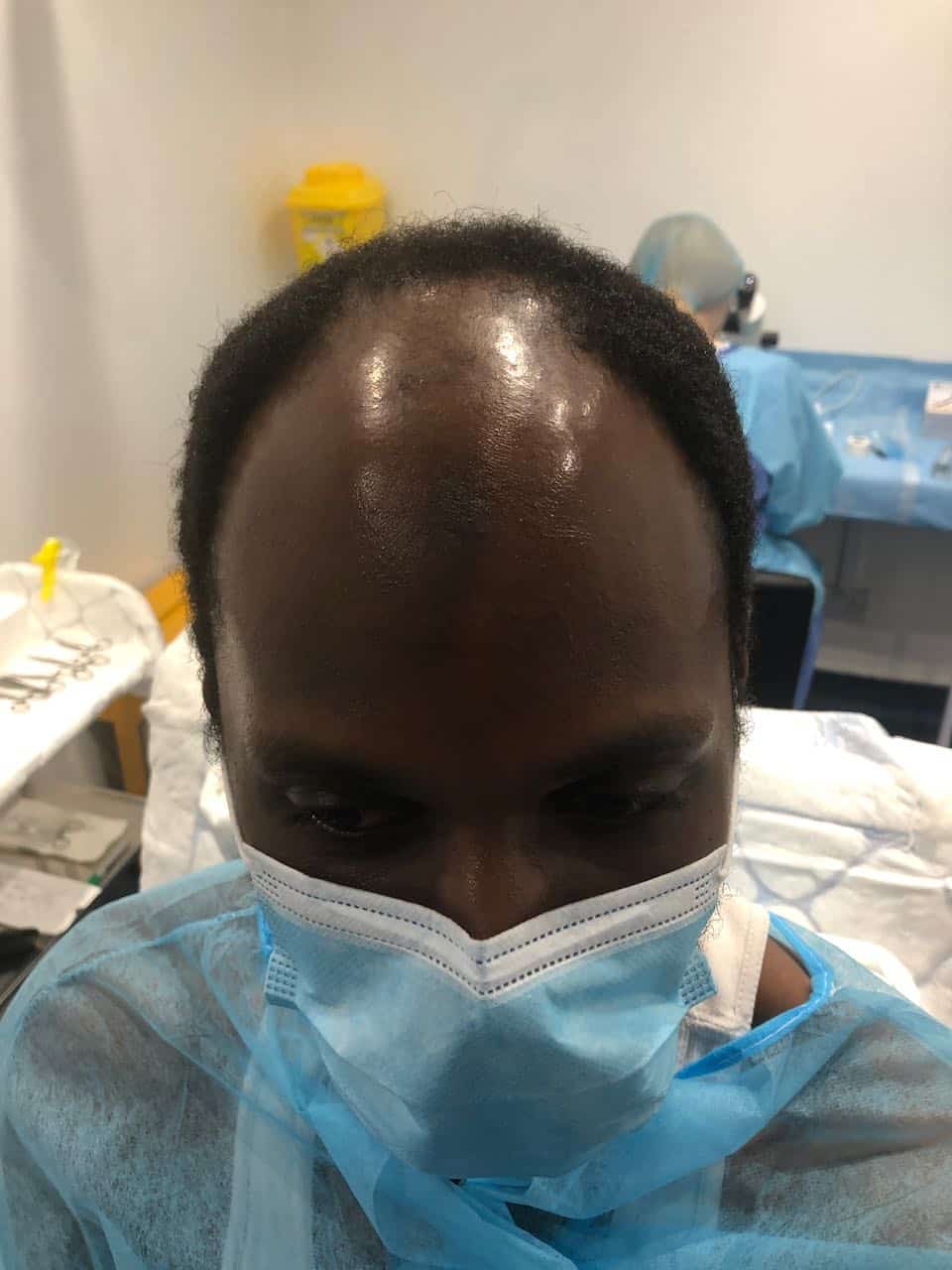 afro hair transplant male just before
