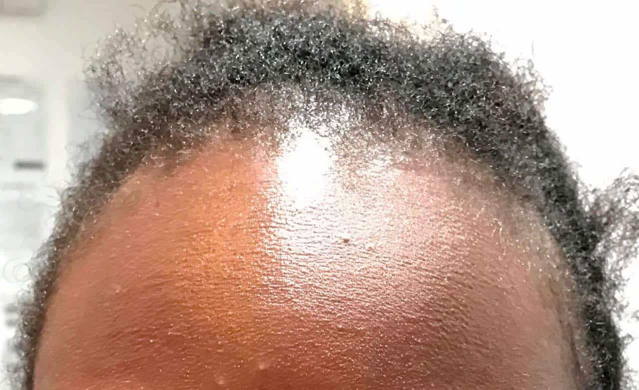 afro hair surgery before front view