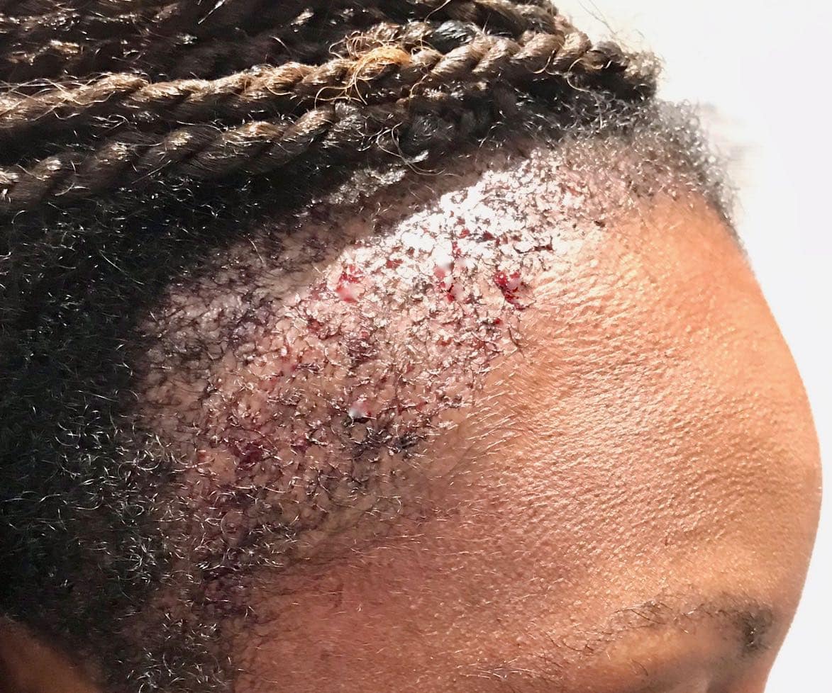 afro hair surgery post right side