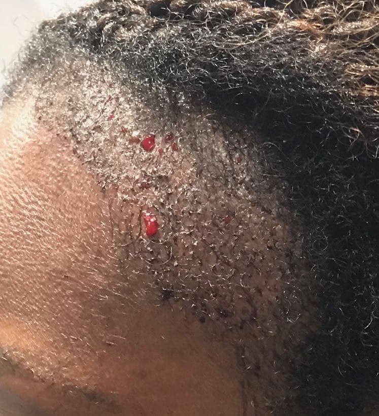 afro hair surgery right post