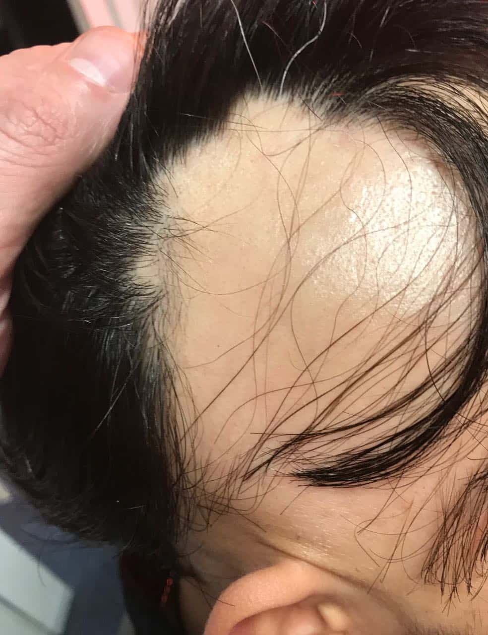 alopecia areata