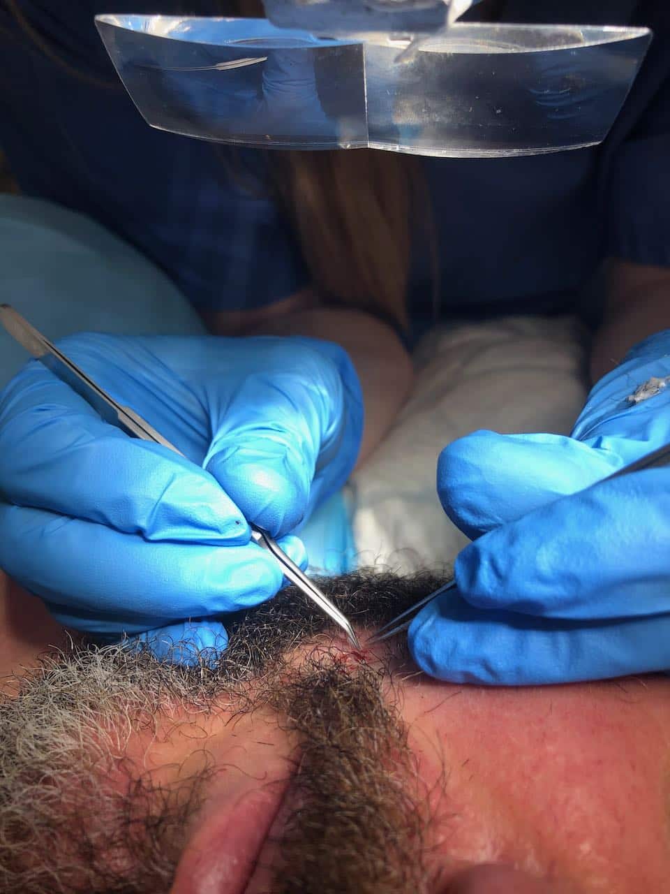 beard transplant placing the grafts