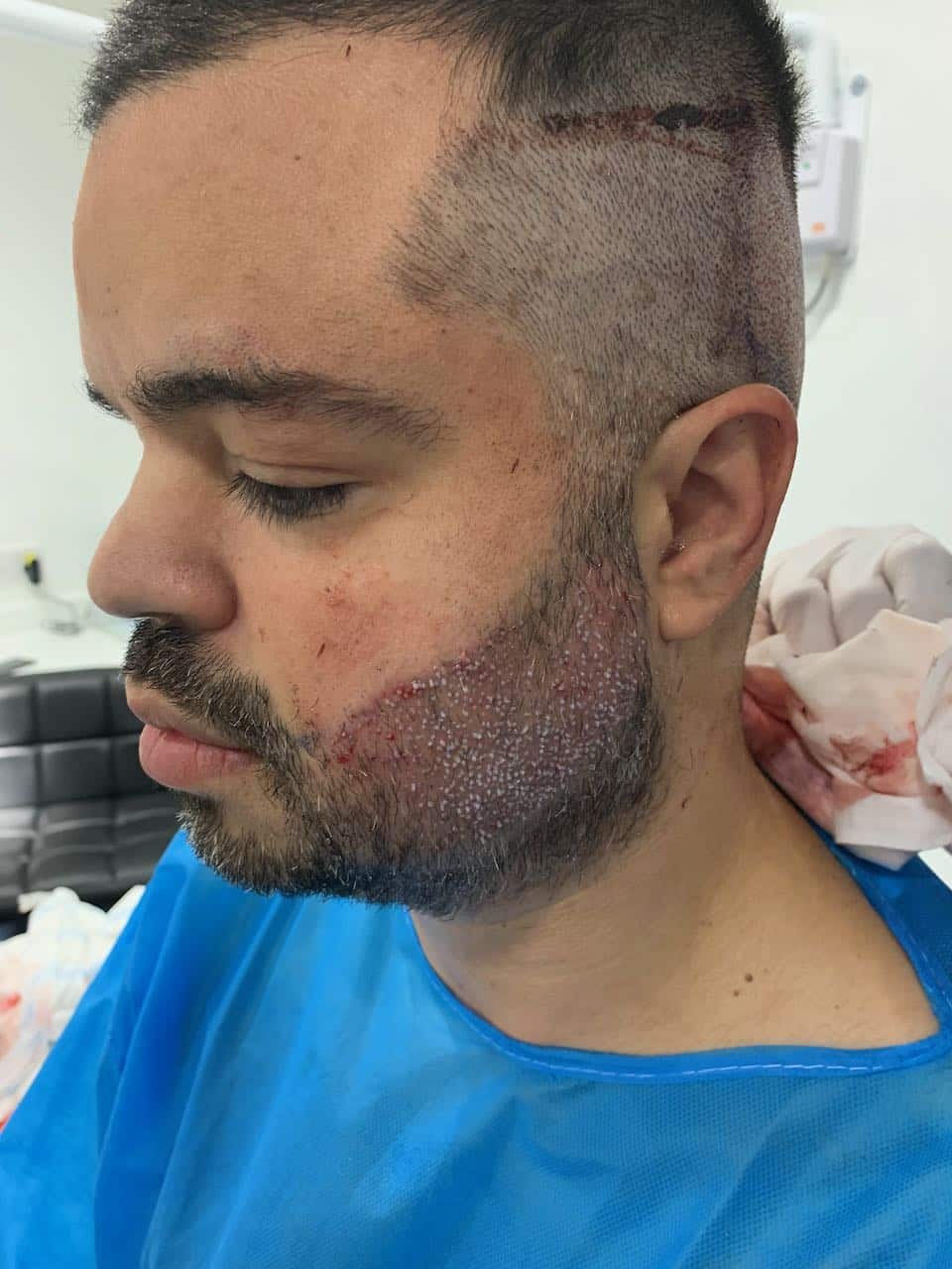 beard transplant rick left post op