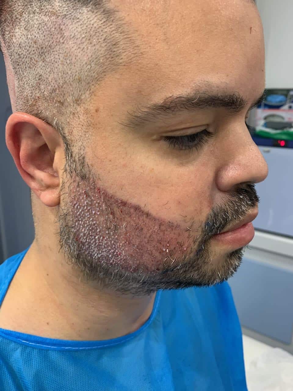 Beard transplant rick right post op
