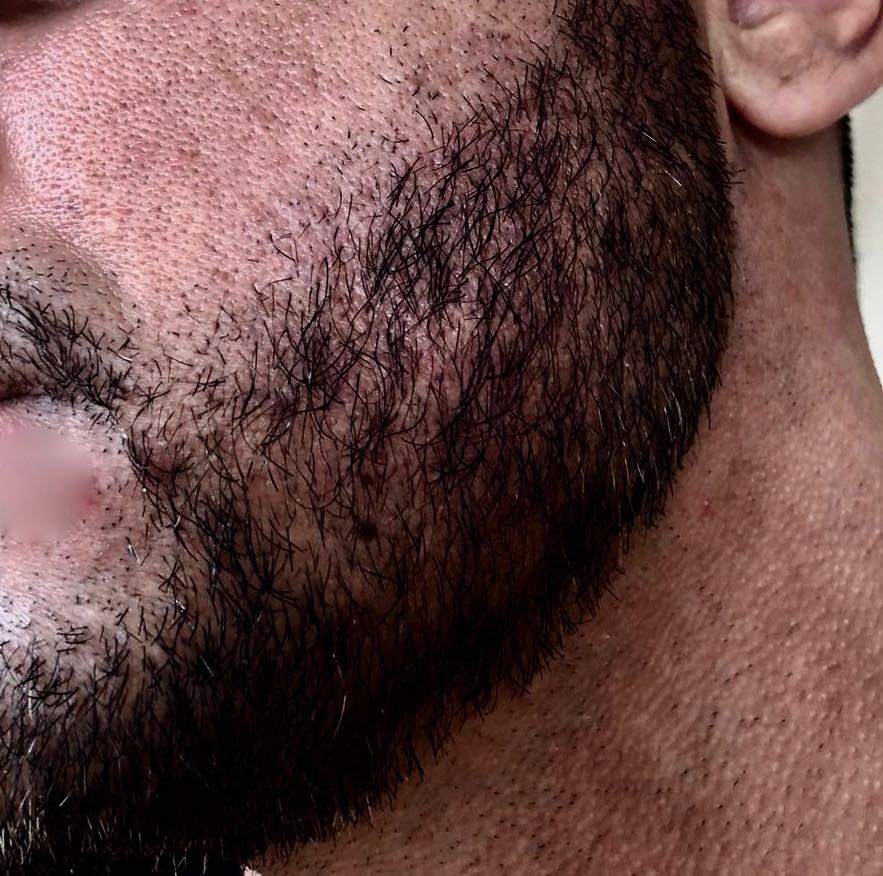 beard after