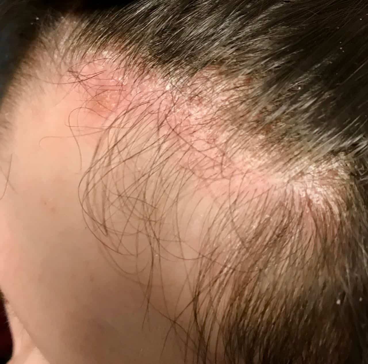 children’s hair loss