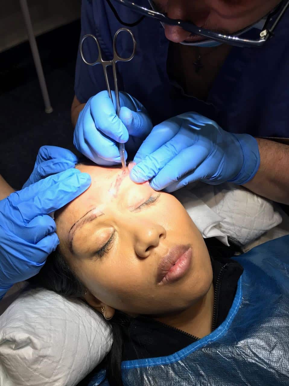 eyebrow transplant Dr sciacca incisions