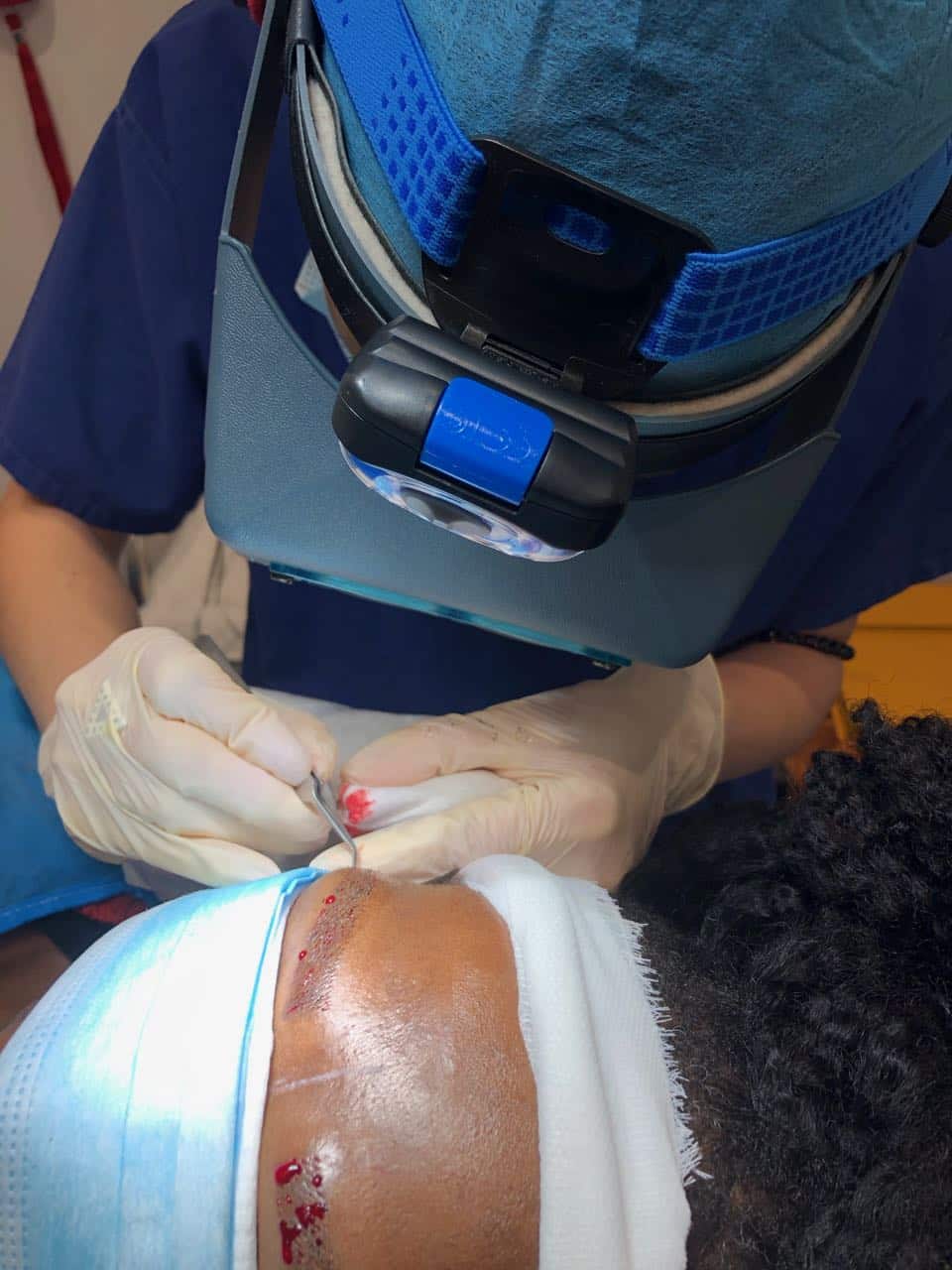 afro eyebrow transplant implant