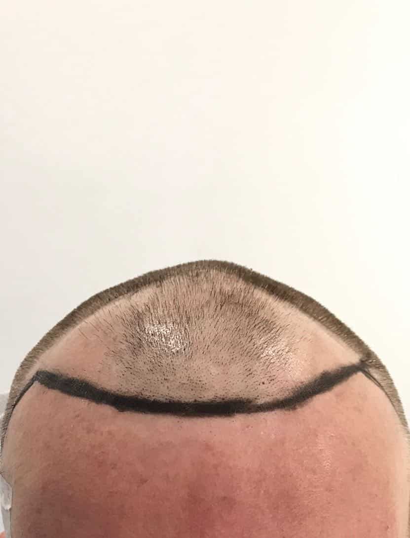fue hair transplant designing