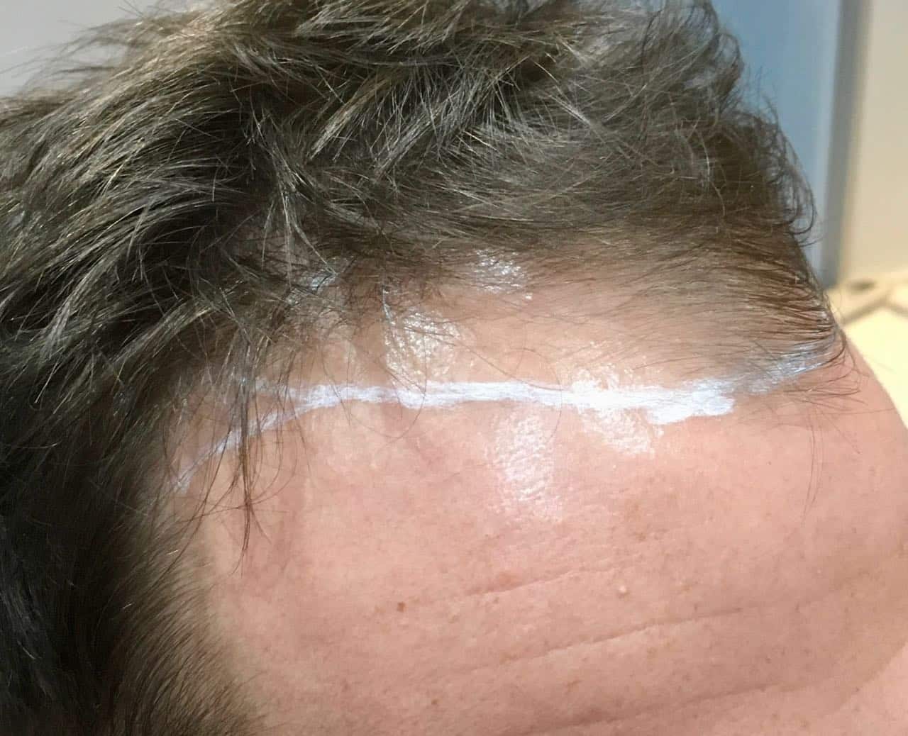 FUE hair transplant before right side