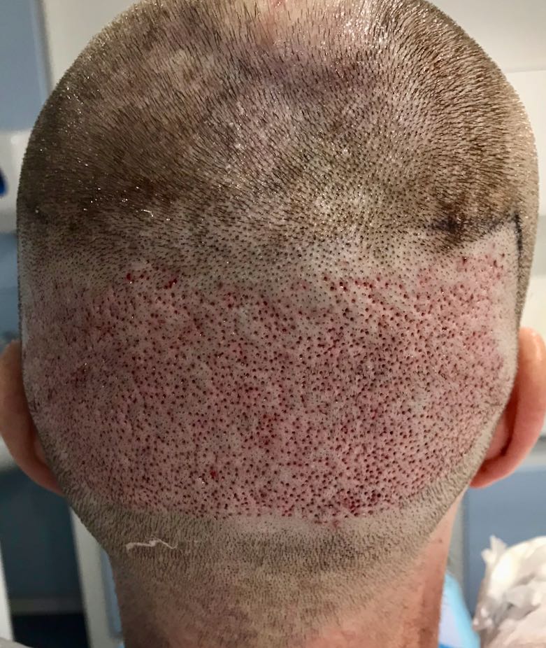 fue hair transplant after extraction donor site