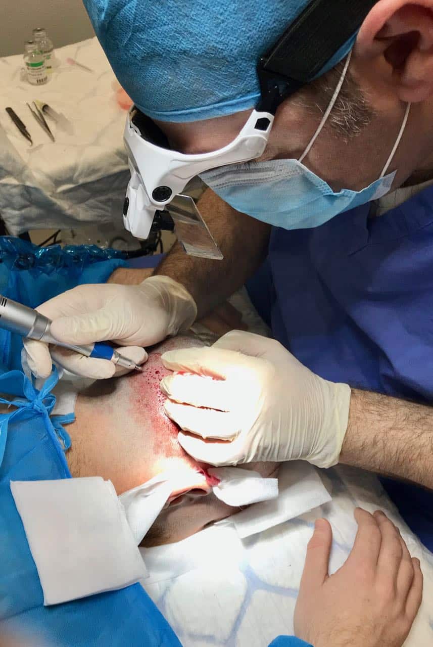 fue hiair transplant Dr Theo extracting