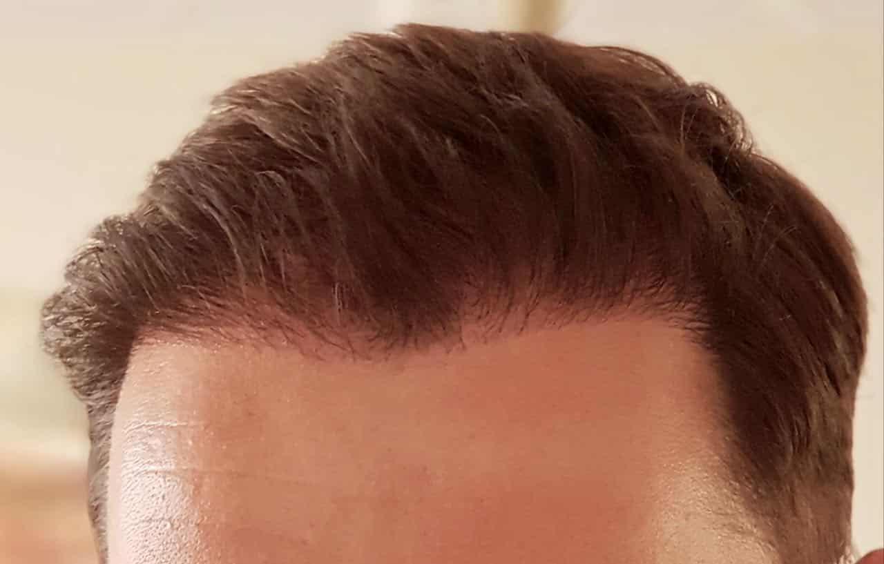 FUE hair transplant afterwards