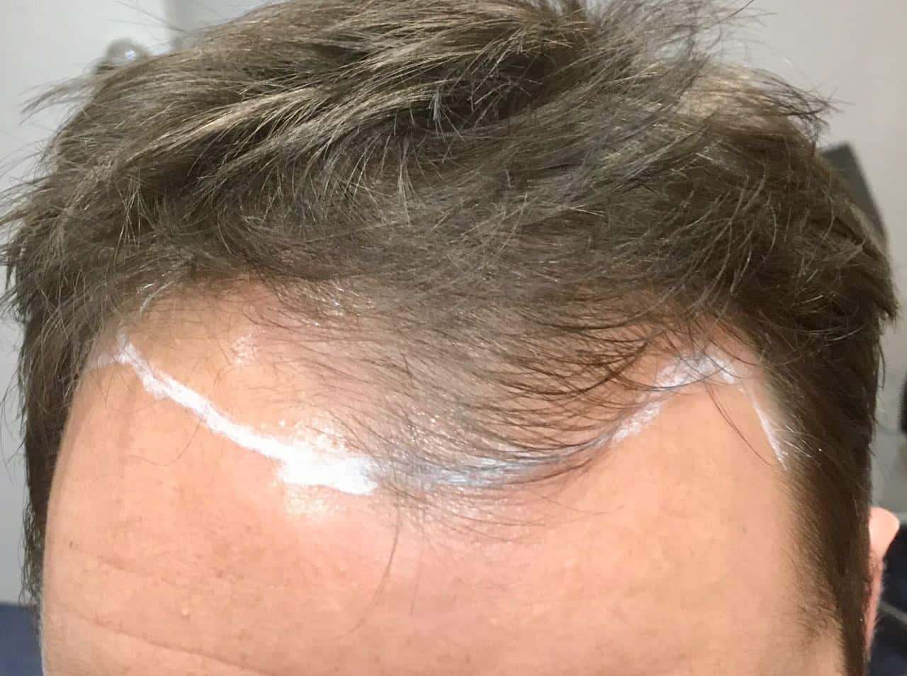 fue hair transplant