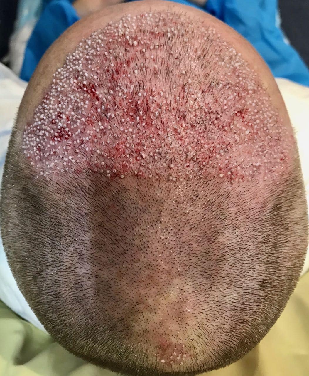 fue hair transplant post operation on the day