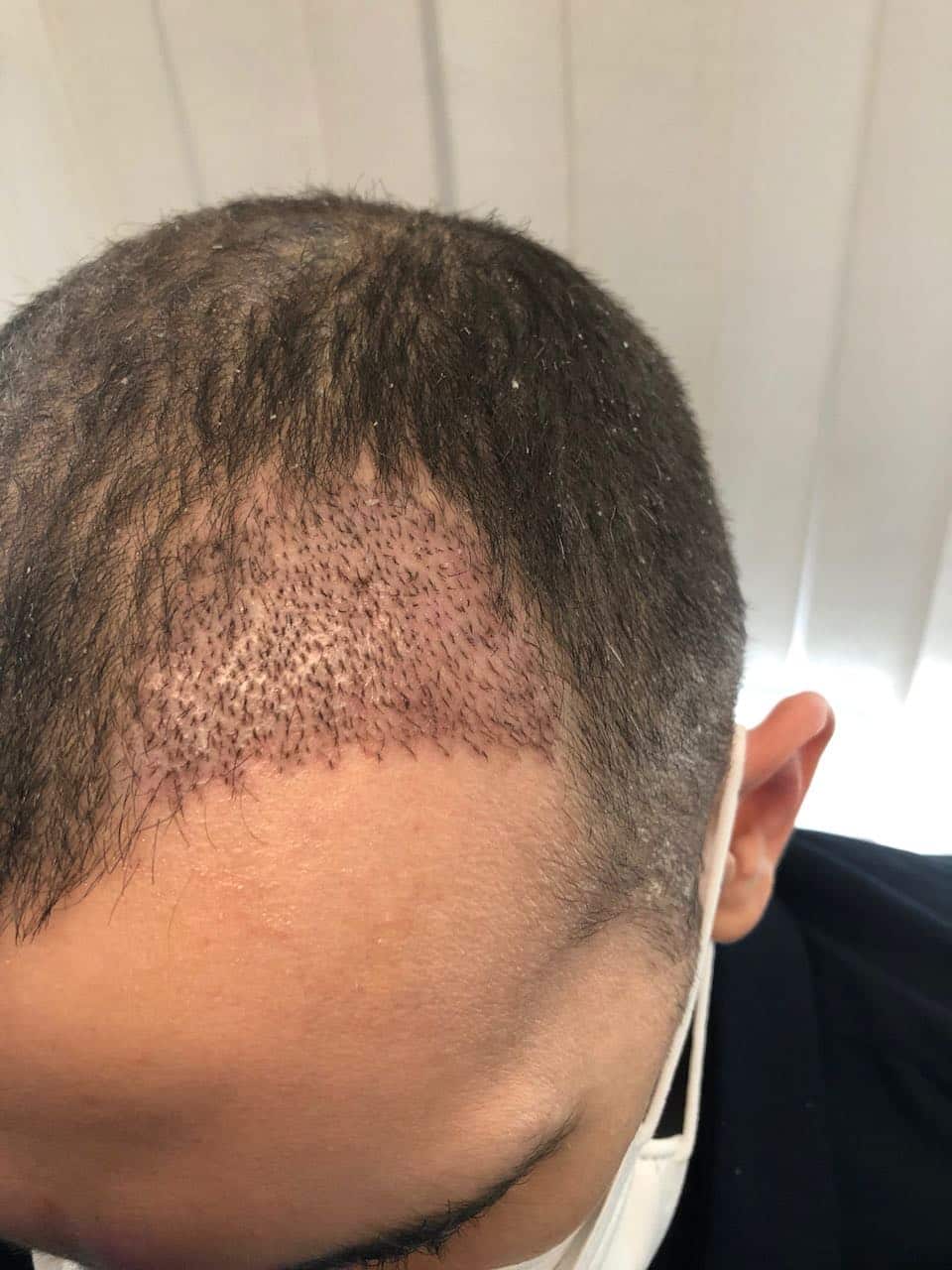 FUE hair transplant left temple