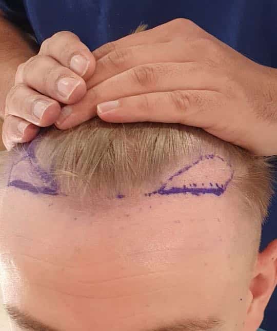 fue hair transplant 1500 grafts temple