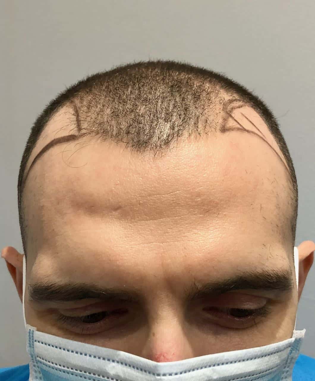 FUE hair transplant temples