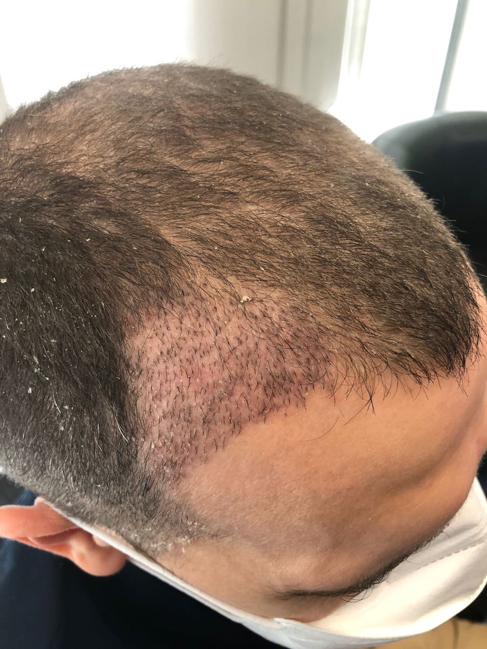FUE hair transplant right temple