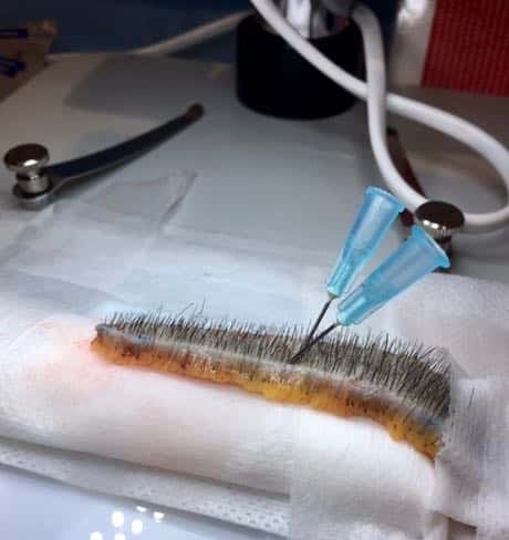 fut hair transplant strip side view