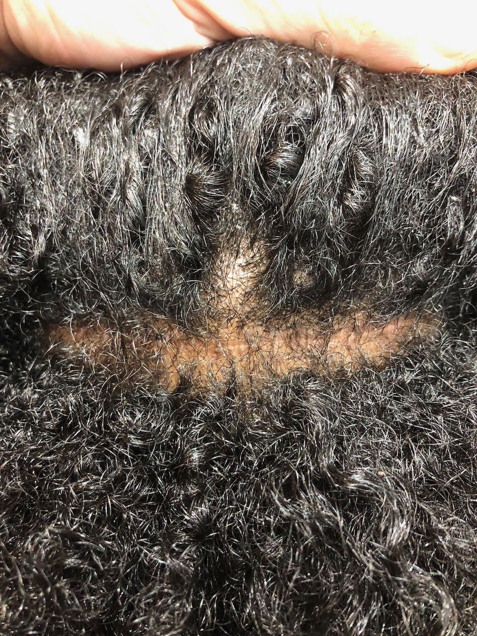 fut hair transplant fut afro healed strip