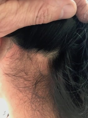 hair loss alopecia areata