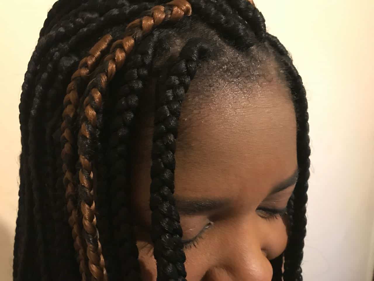 traction alopecia joy