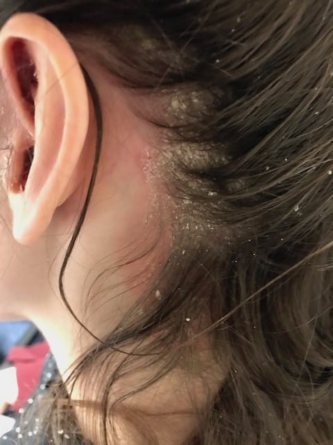Scalp Disease hair line