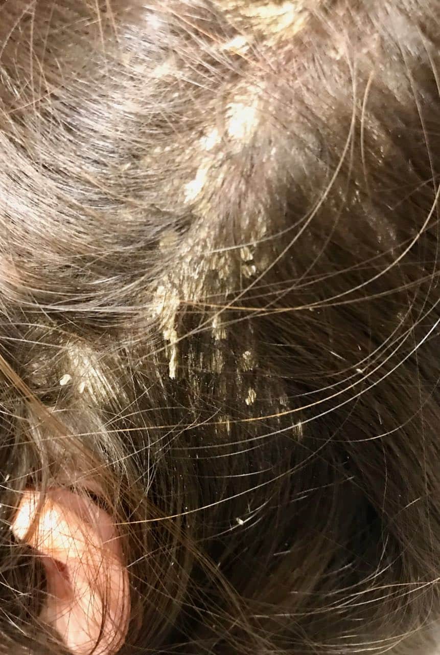 scalp psoriasis on the head
