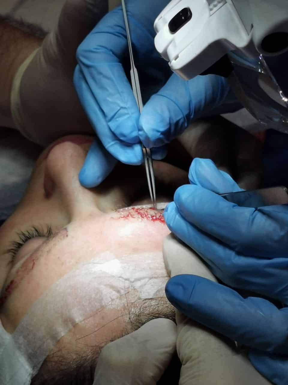women hair transplant