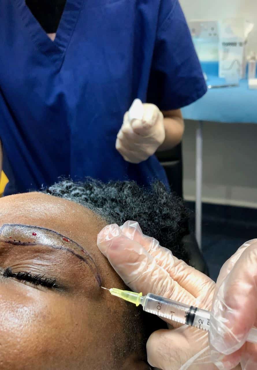 womens hair transplant