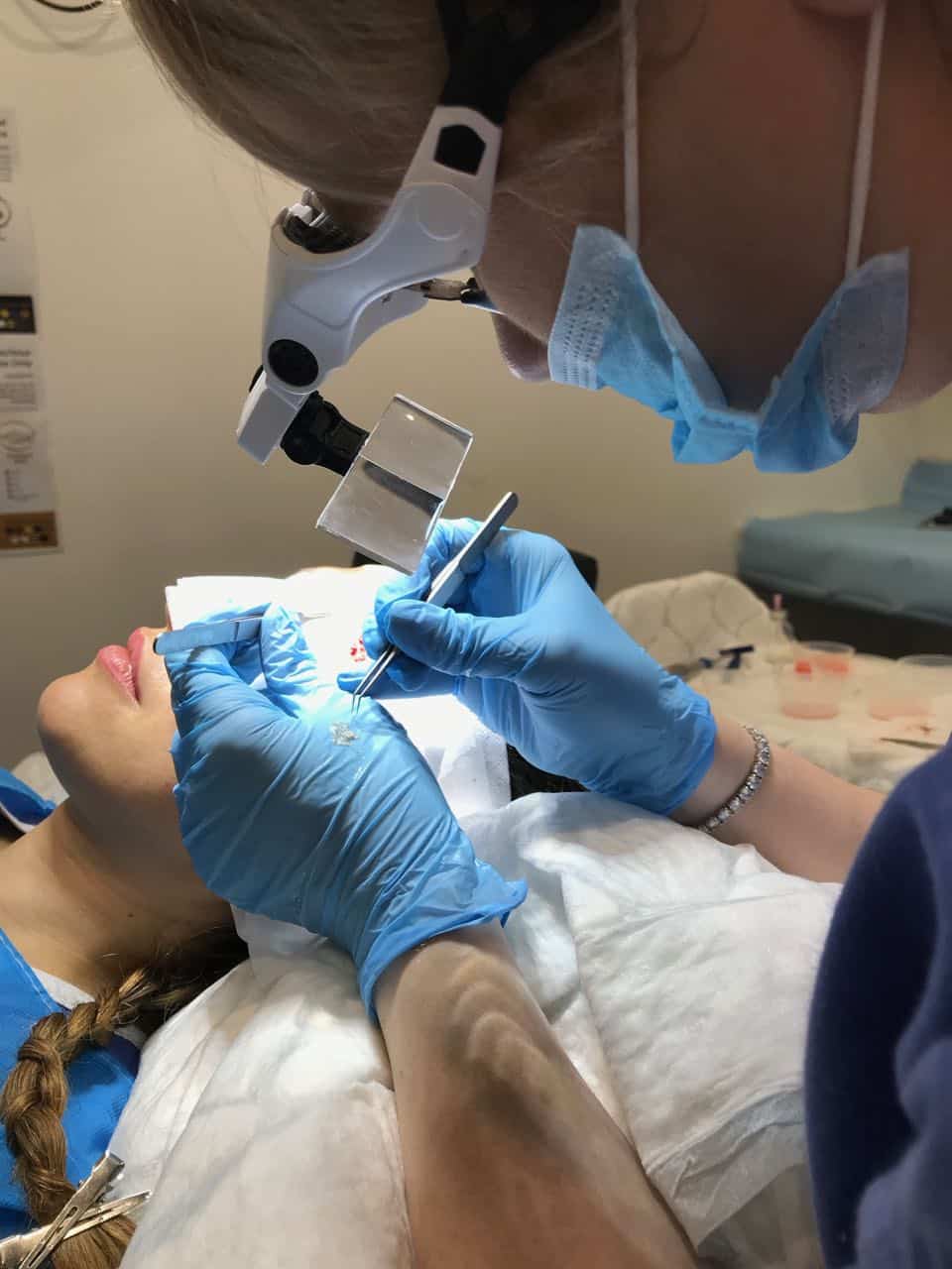 womens hair transplant eyebrows