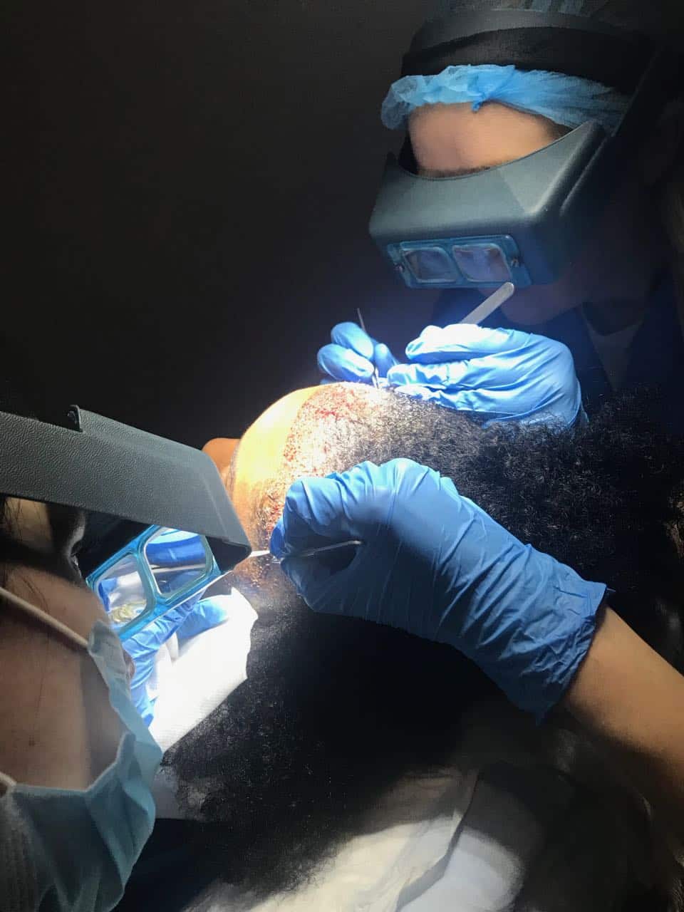 womens hair transplant afro