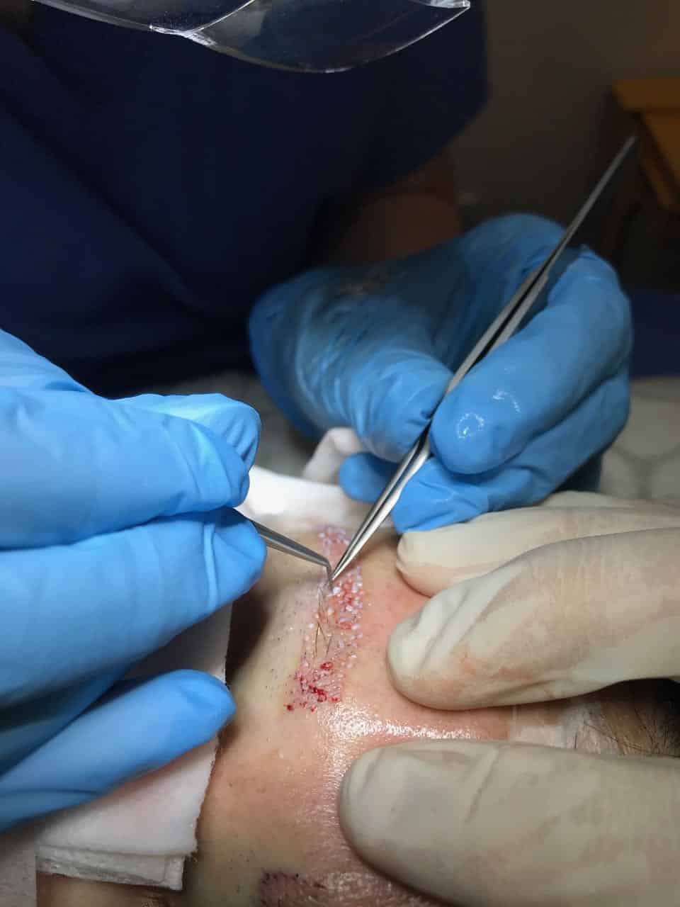 womens hair transplant eyebrow placement
