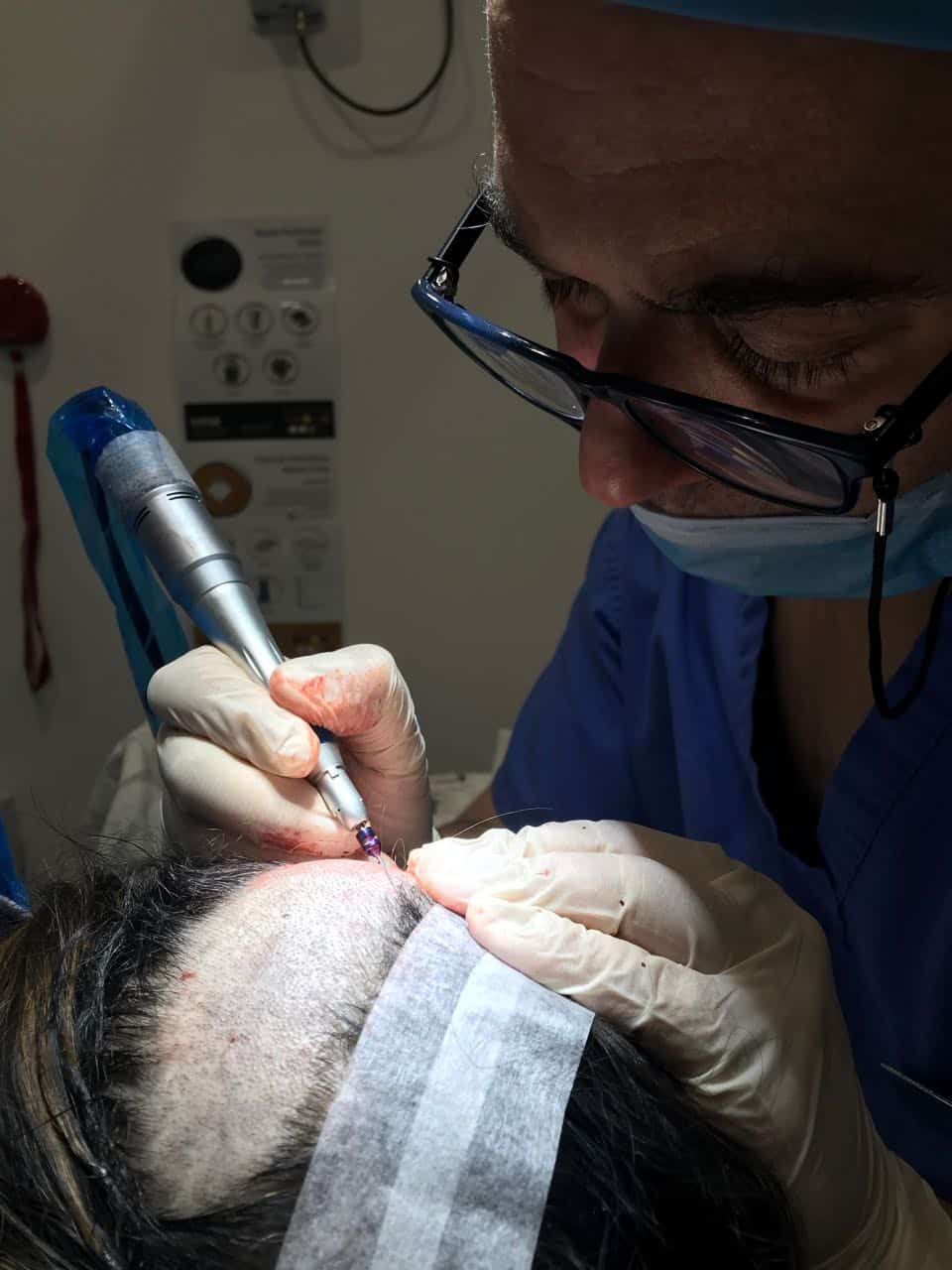 womens hair transplant FUE