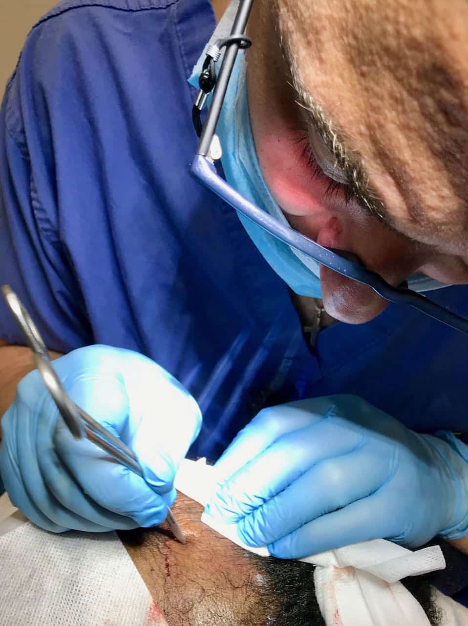 womens hair transplant incisiions
